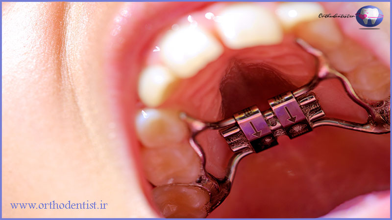 تاثیر ارتودنسی روی صحبت کردن