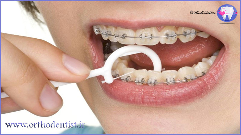 پوسیدگی دندان در حین ارتودنسی