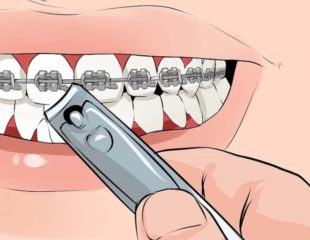 انتظارات بعد از تنظیم کردن سیم ارتودنسی