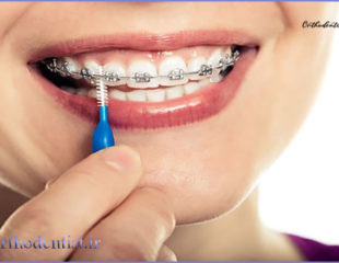 جلوگیری از پوسیدگی دندان با وجود ارتودنسی