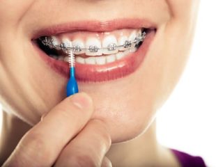 جلوگیری از پوسیدگی دندان حین ارتودنسی