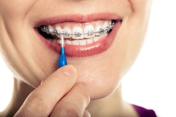 جلوگیری از پوسیدگی دندان حین ارتودنسی