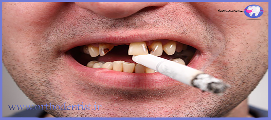 تاثیر سیگار بر ارتودنسی