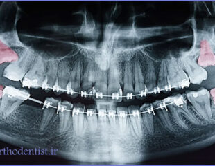 دندان عقل و ارتودنسی