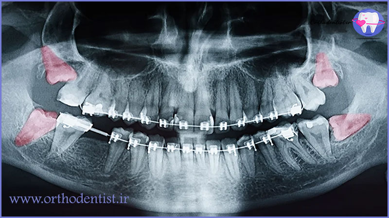 دندان عقل و ارتودنسی