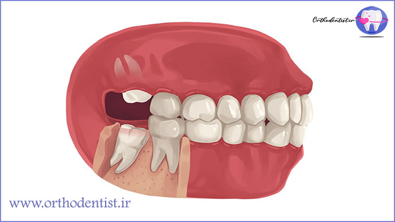 کشیدن دندان عقل و ارتودنسی