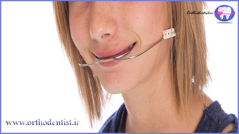 Orthodontic headgear