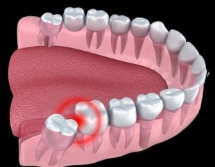کشیدن دندان عثل و ارتودنسی