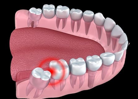 کشیدن دندان عثل و ارتودنسی