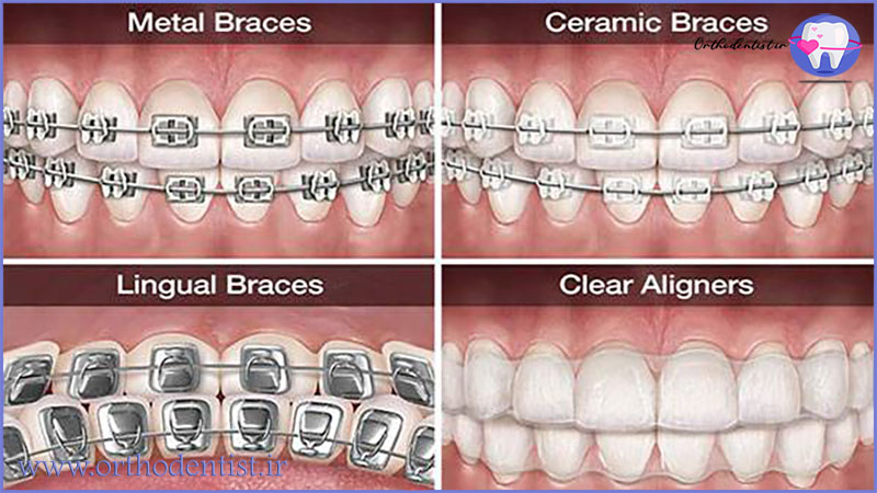 انواع ارتودنسی