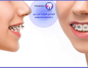 ارتودنسی همزمان با عمل بینی