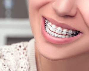 ارتودنسی طرح دار