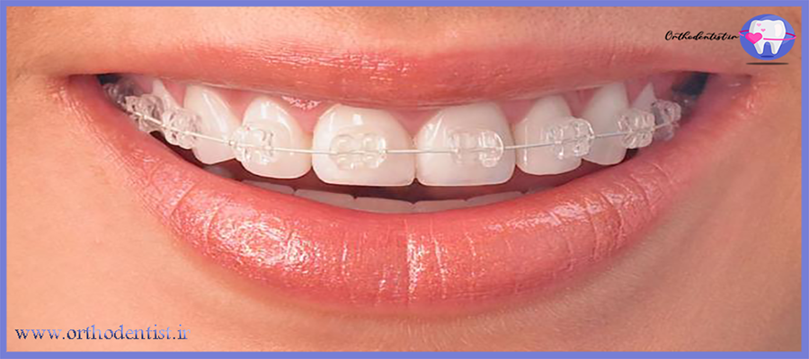 ارتودنسی رنگی دندان