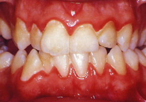 در ارتودنسی کدام دندان را می‌شکنند، بیماری لثه