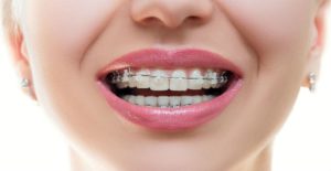 در ارتودنسی کدام دندان را می‌شکنند