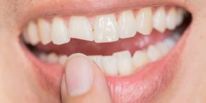 در ارتودنسی کدام دندان را می‌شکنند، شکستن دندان