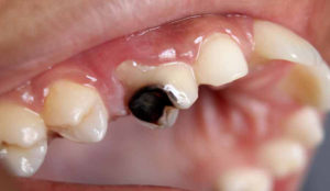 در ارتودنسی کدام دندان را می‌شکنند، پوسیدگی دندان