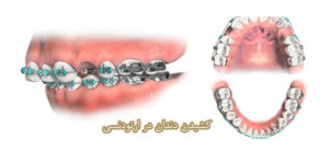 در ارتودنسی کدام دندان را می کشند
