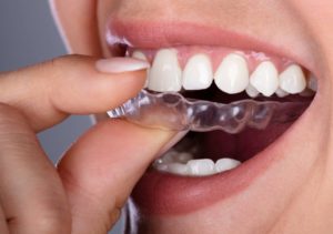 ارتودنسی اینویزیلاین