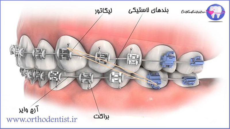 ساختار بریس ها