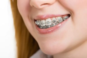ارتودنسی دندان چگونه است