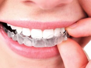 بریس اینویزیلاین