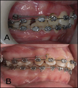 ضرر های ارتودنسی دندان-3