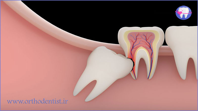 دندان عقل نهفته