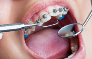 ضرر های ارتودنسی دندان-2