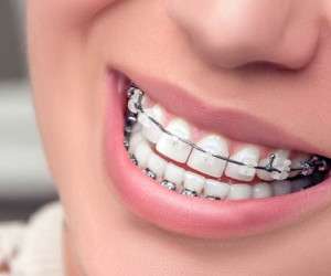  ارتودنسی زیبایی دندان