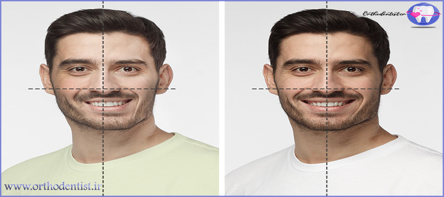 ارتودنسی برای صورت نامتقارن