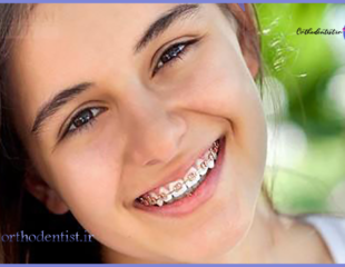 بریس های تقلبی