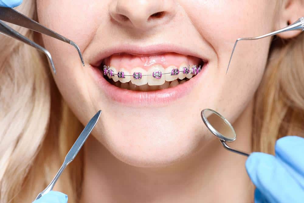 قیمت ارتودنسی کاموفلاژ