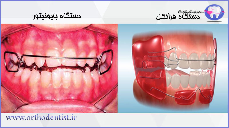 دستگاه بایونیتور