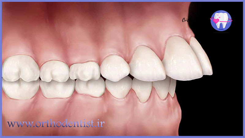 ارتودنسی دو دندان جلو چیست