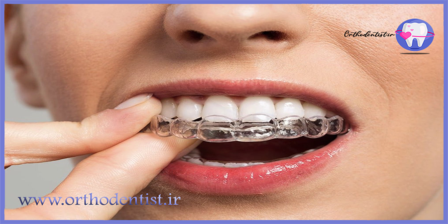 درمان ارتودنسی دو دندان جلو