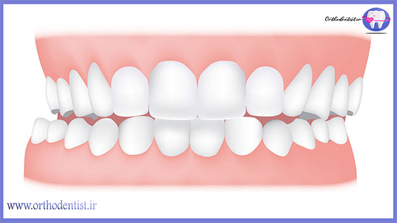 ارتودنسی برای صورت نامتقارن