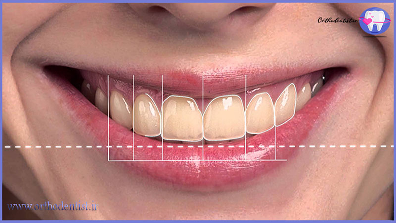 ارتودنسی طرح لبخند