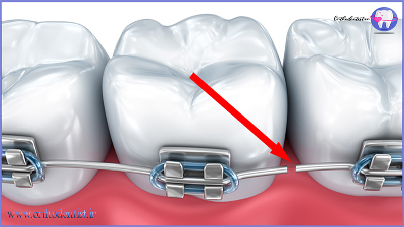 شکسته شدن براکت و یا سیم ارتودنسی