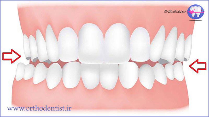 عدم هماهنگی دندان ها و فکین