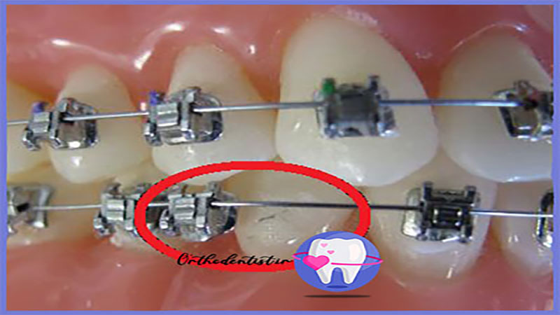 افتادن نگین ارتودنسی
