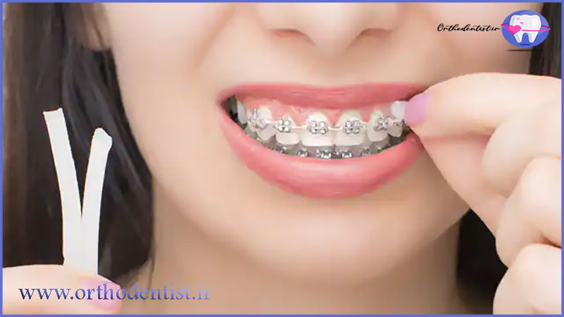 مراقبت از موم ارتودنسی