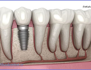 ایمپلنت دندان