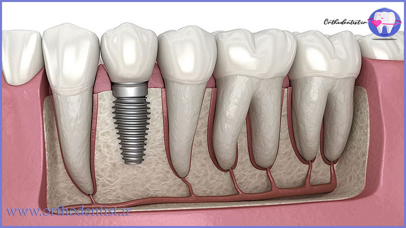 ایمپلنت دندان