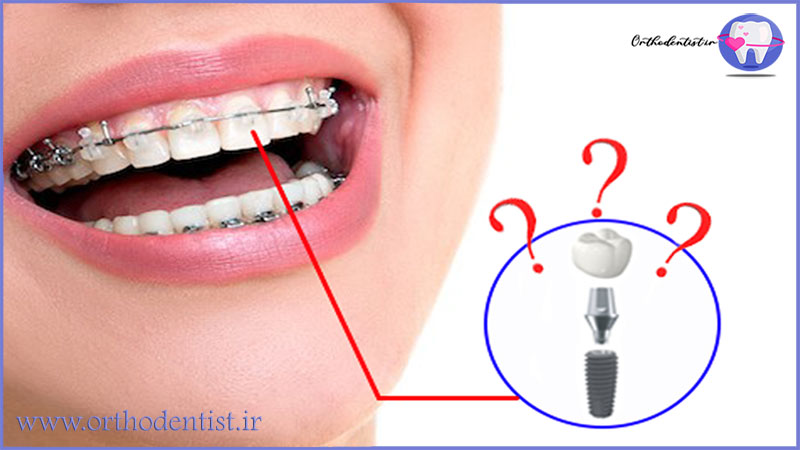 ایمپلنت دندان به عنوان لنگرگاه بریس