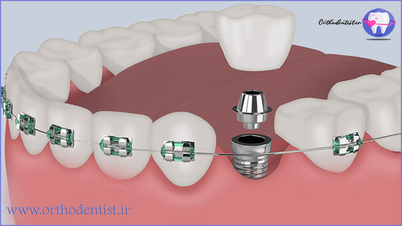 آیا ایمپلنت دندان بهتر است بعد از ارتودنسی باشد؟