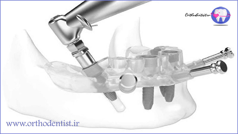 ایمپلنت های دندانی مدرن
