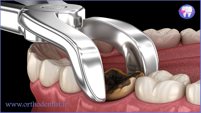 کشیدن دندان