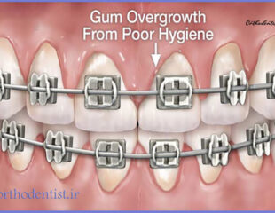 التهاب لثه در ارتودنسی