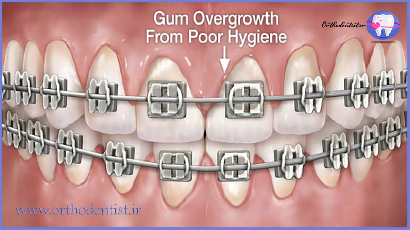 التهاب لثه در ارتودنسی